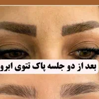 ریموو  هر نوع تتویی  کاملا تضمینی اف خورده|خدمات آرایشگری و زیبایی|کرمانشاه, |دیوار