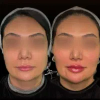 لیفت صورت،ژل و مزوژل،بوتاکس،لیزر،در کلینیک