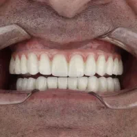 اوردنچر دو فک ۱۰۰ تومن در تبریز