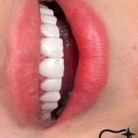 کامپوزیت دندان ( مدل تبلیغاتی)