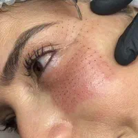 برداشتن گوشت اضافه صورت وبدن|خدمات آرایشگری و زیبایی|اصفهان, کوجان|دیوار