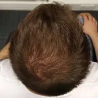 ریزش مو (درمان کم پشتی و نازکی مو)