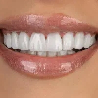 کامپوزیت دندان از دم قسط|خدمات آرایشگری و زیبایی|تهران, بلوار کشاورز|دیوار