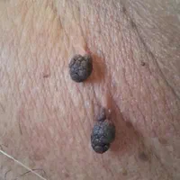 برداشتن خال زگیل گوشت اضاف برداشت زگیل تناسلی|خدمات آرایشگری و زیبایی|شیراز, معالی‌آباد|دیوار