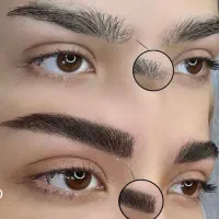 فیبروز میکروبلیدینگ.