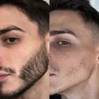 درمانـریش و سیبیل
