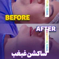 ساکشن غبغب وتزریق چربی بصورت و هرناحیه ازبدن درمطب|خدمات آرایشگری و زیبایی|قم, زنبیل آباد|دیوار