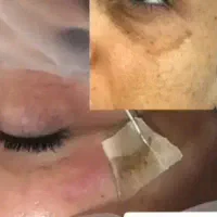 تنها با یک جلسه شاهد ازبین بردن لکت باش