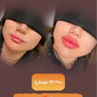 کلینیک بوتاکس ، ژل ، هایفو ، لیزر ، مزوتراپی
