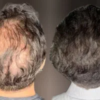 آموزش و خدمات میکرواسکالپ ،اسکراب ،مکمل کاشت مو|خدمات آرایشگری و زیبایی|مشهد, صیاد شیرازی|دیوار