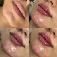 ژل بوتاکس پیرسینگ مزوژل آنزیم آموزش|خدمات آرایشگری و زیبایی|اسلام‌‌آباد غرب, |دیوار