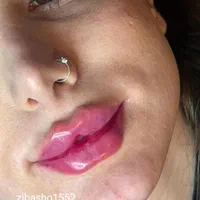 ژل بوتاکس