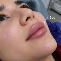 تخفیف فیلر و بوتاکس