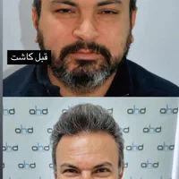 کاشت مو درکلینیک مجوزدار و پزشک متخصص با چک صیادی|خدمات آرایشگری و زیبایی|تهران, سعادت‌آباد|دیوار