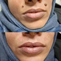 خدمات خالبرداری،برداشتن منگوله گوشتی|خدمات آرایشگری و زیبایی|تهران, مسعودیه|دیوار