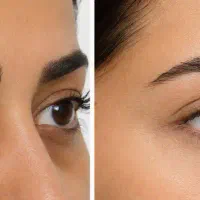 بلیچینگ وایتنینگ روشن کردن نواحی تیره بدن اصفهان