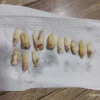 کشیدن دندان در محل شخص خوی و سلماس