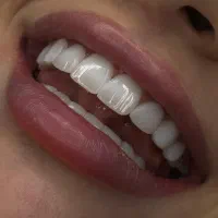 دندان پزشکی کامپوزیت