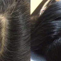 میکرو اسکالپ موی سر ،ریش، ابرو( در محل)|خدمات آرایشگری و زیبایی|تهران, سعادتآباد|دیوار