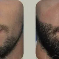 پرپشتی ریشات دست منه
