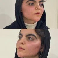 مدل جهت تزریق چربی/انجام بلفاروپلاستی|خدمات زیبایی و سلامت|تهران, شکوفه (عبدل آباد)|دیوار