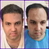 پیوند مو و ابرو در تهران در کلینیک معتبر|خدمات آرایشگری و زیبایی|کاشان, امیرکبیر|دیوار