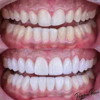 کامپوزیت دندان(درمان دندانپزشکی وقت‌دهی اورژانسی)