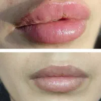 تزریق فیلر و کاشت ناخن|خدمات آرایشگری و زیبایی|خواف, |دیوار