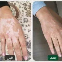 پایان خارشات دسته منه