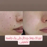 ابرو/لیزر پوست /شیدینگ/لیزر مو سفید/درمان کبد چرب|خدمات آرایشگری و زیبایی|خرم‌آباد, |دیوار