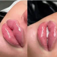 جذب نیروی کار تتو طب سنتی فشیال لیزر