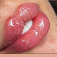 جشنواره تخفیف تزریق ژل و بوتاکس