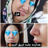 تخفیفات آنزیم بوتاکس صورت فیلر فول فیس و...|خدمات آرایشگری و زیبایی|مشهد, شهید فرامرز عباسی|دیوار