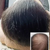 میکرواسکالپ جایگزین کاشت مو