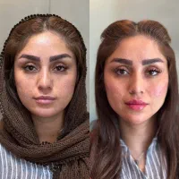 تزریق چربی به صورت به روش نانو‌فت فقط ۷/۵