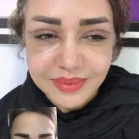 بلفارو پلاستی پلک بالا و پایین
