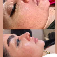 درمان مشکلات پوستی|خدمات آرایشگری و زیبایی|شاهین دژ, |دیوار