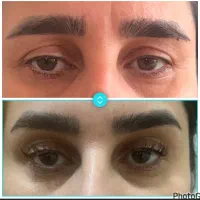 مزوتراپی مو ،ژل،بوتاکس|خدمات زیبایی و سلامت|تهران, بلوار کشاورز|دیوار