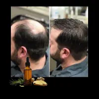 رویش‌مجدد.پرپشتی.حجم اوری.تقویت رسانی مو ریش