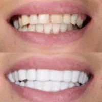 لمینت متحرک دندان|آرایشی، بهداشتی، درمانی|سنندج, |دیوار