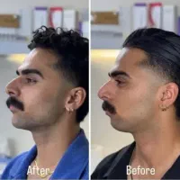 ژل لب بوتاکس فیلر بادی بینی لیفت صورت فیلرصورت چشم|خدمات زیبایی و سلامت|اصفهان, خانه اصفهان|دیوار