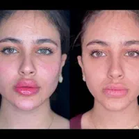 جشنواره ژل بوتاکس.فیلرلیفت نخ.بوتاکس.انزیم.پی ارپی|خدمات آرایشگری و زیبایی|مشهد, سناباد|دیوار