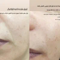 زیبایی ماندگار آرایش دائم / تزریق ژل و بوتاکس|خدمات آرایشگری و زیبایی|شوشتر, |دیوار