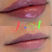 جشنواره ژل و بوتاکس درکلینیک پوست ومو