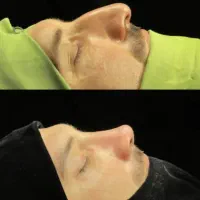 عمل بینی بادستگاه پیزوسرجری وNSK(جشنواره تابستانه)|خدمات آرایشگری و زیبایی|کاشان, میدان کهنه|دیوار