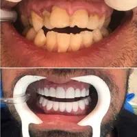 جشنواره دندان ونیر کامپوزیت روکش لمینیت عصب  IMAX|خدمات آرایشگری و زیبایی|تهران, هفت حوض|دیوار