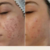 فیشال و مزونیدلینگ پوست و لیفت مژه ابرو و کاشت مژه