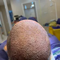 کاشت مو پرتراکم با تضمین 100٪