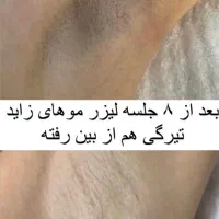 لیزر فقط ‌فقط 690تومان