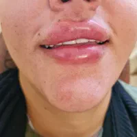 تزریق تخصصی ژل و بوتاکس رشت|خدمات آرایشگری و زیبایی|رشت, بلوار گیلان|دیوار